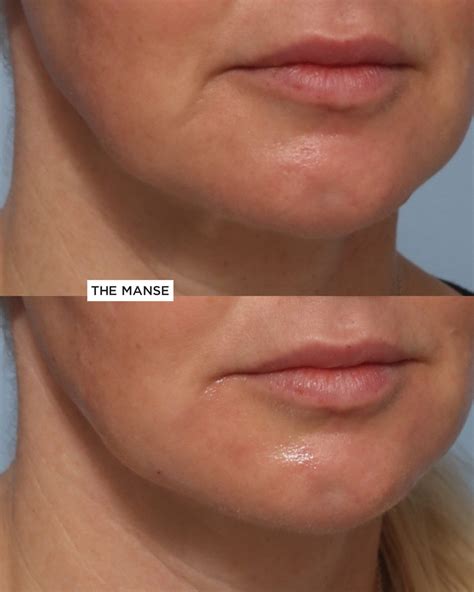 Lower third of face injections including Marionette Filler - Best Clinic Sydney for Dermal Fillers