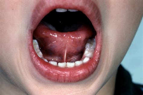 - Tongue Tie