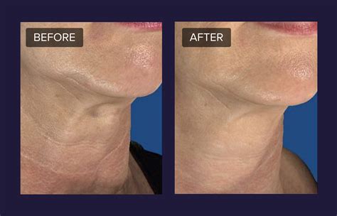 How deep should Microneedling go for optimal tightening? Female, 56