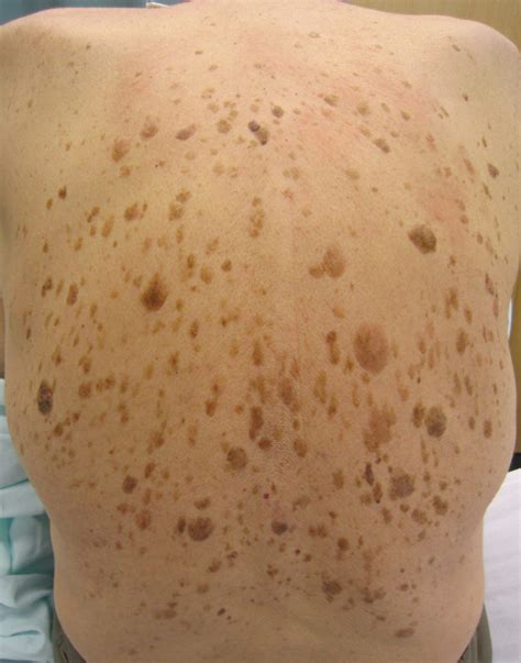 Seborrheic Keratosis - RSB Skincare