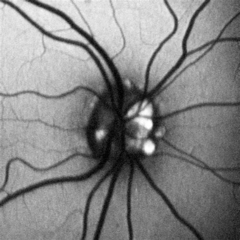 OCT angiography in optic disc drusen: comparison with structural and functional parameters ...