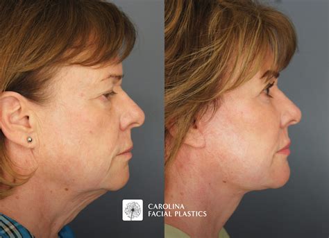 Lower Face & Neck Lift, Platysmaplasty, Quad Blepharoplasty, Fat Grafting, and CO2 Laser ...