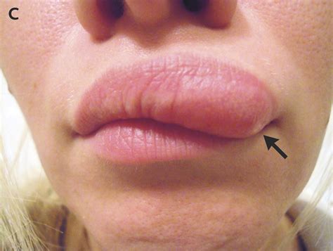 What Is The Lump On My Bottom Lip at Clifford Bloss blog