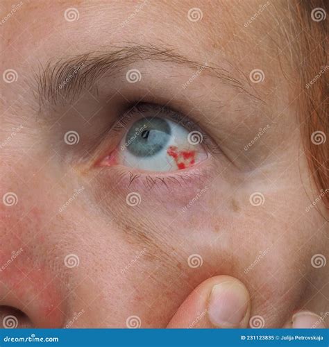 Subconjunctival Hemorrhage or Subconjunctival Bleeding, Hyposhagmus. Bleeding Under the ...