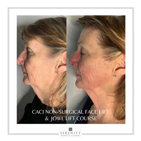 Non-Surgical Facial Lift - Serenity Beauty Clinic in Staffordshire