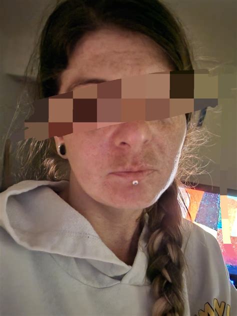 Any one else have facial swelling? : r/lupus