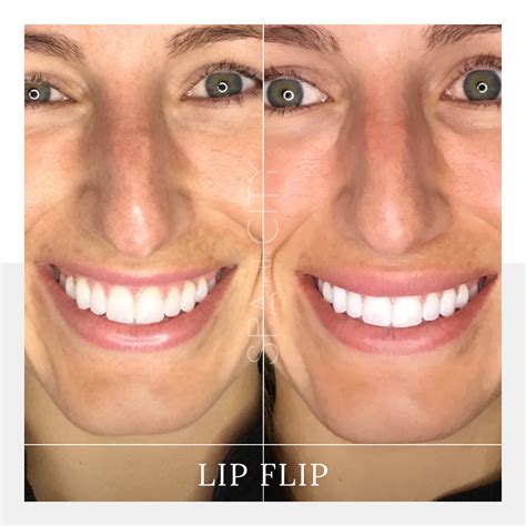 Botox Lip Flip Before & After | Botox lips, Gummy smile botox, Lips