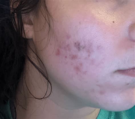 Rinvoq Acne? : r/Rinvoq
