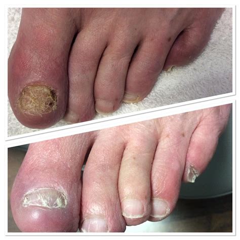 Toenail Fungus Uncovered : Causes, Symptoms, Care - Public Health