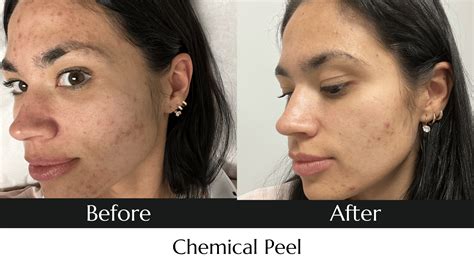 Chemical Peels