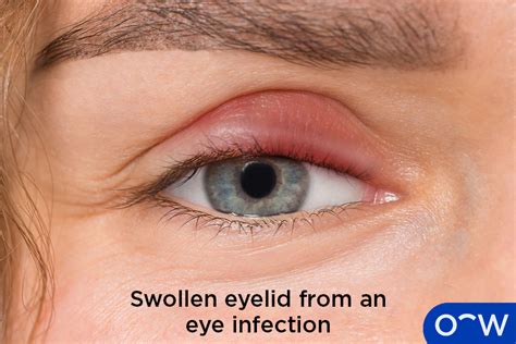 Baby Getting Gunk In Eye at James Marts blog