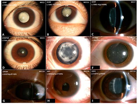 Posterior Subcapsular Cataract
