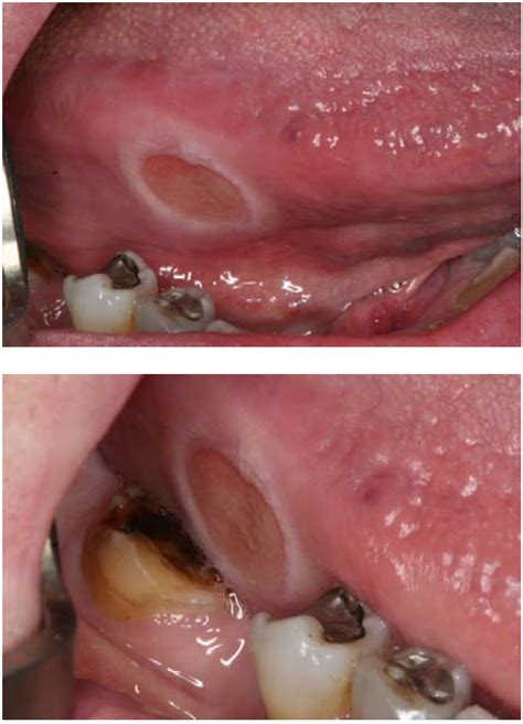 Benign Inflammatory Lesions/Conditions of Oral Mucous Membranes ...