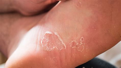 Foot Fungal Infection Blisters