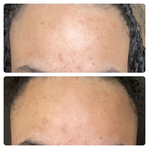 Does azelaic acid cause a purge? : r/tretinoin