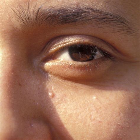 Small White Pimple On Face