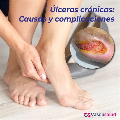 Úlceras crónicas: Causas y complicaciones