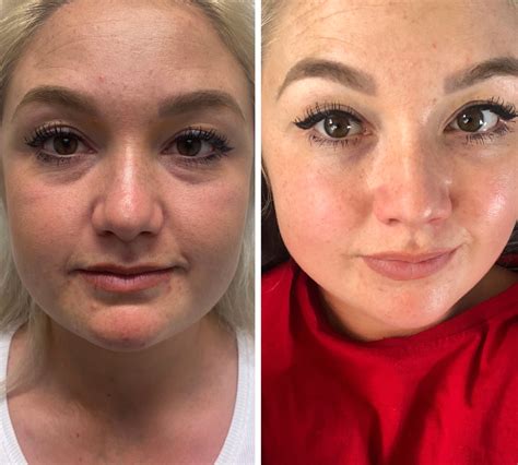 Non Surgical Face Lift Pros And Cons at Ellie Roseby blog