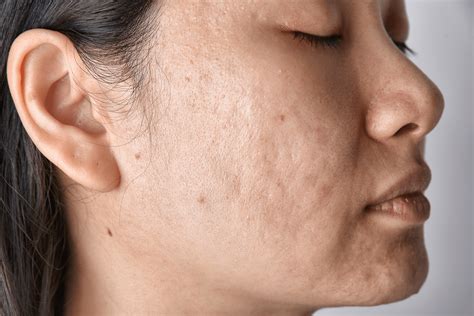 Types of Acne Scars & How to Treat Them | Dr. Dennis Gross