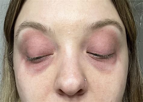 Redness/Rash on Eyelids, Upper Eyelids, and Lower Eyelids : r/DiagnoseMe