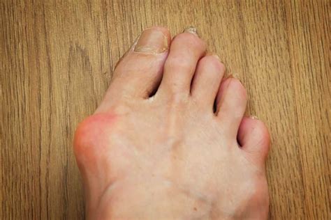 Bunion on the Heel | How to Prevent Bunions
