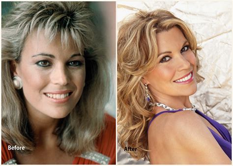 Vanna Before Surgery