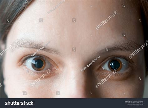 Eye Drops Dilate Pupils at Leo Stonham blog