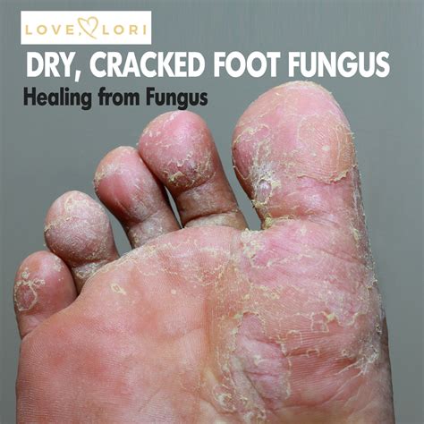 Painful Dry Skin On Bottom Of Foot on Sale | emergencydentistry.com