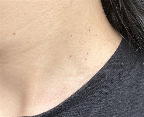 Skin Tags On Neck