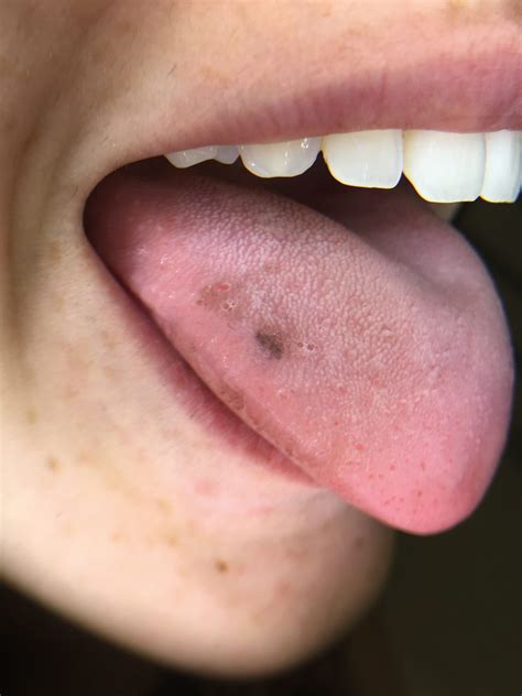 Black Spots on Tongue: Causes, Symptoms, and When to Seek Medical Advice