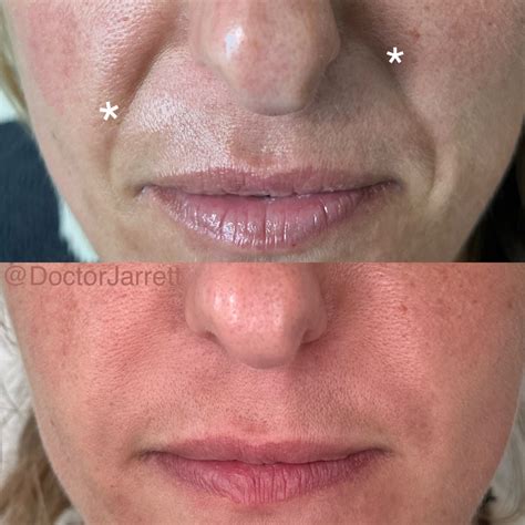 Smile Lines & Nasolabial Fold Fillers - Designer Aesthetics by Dr. Jarrett Schanzer | Miami