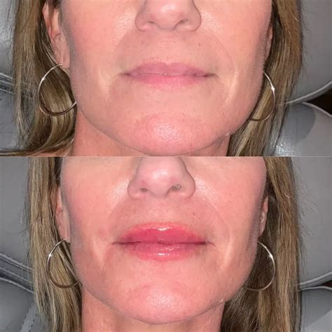 Lip Flip Before and After - Before After Journey