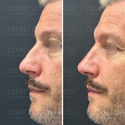 Evaluating Nose Fillers - Cosmetic Connection