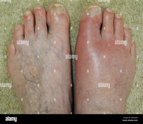 Sore Feet Gout at Timothy Mears blog