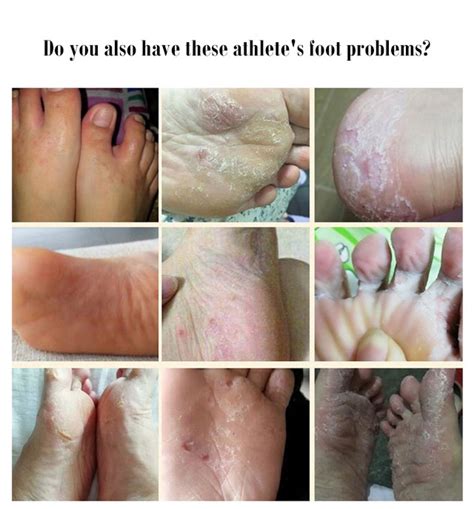 【Stop itching one second】1/2/3PCS Athlete's foot treatment herbal ...
