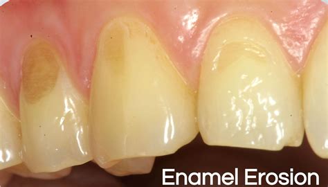 Enamel Erosion - Dental Implant Center