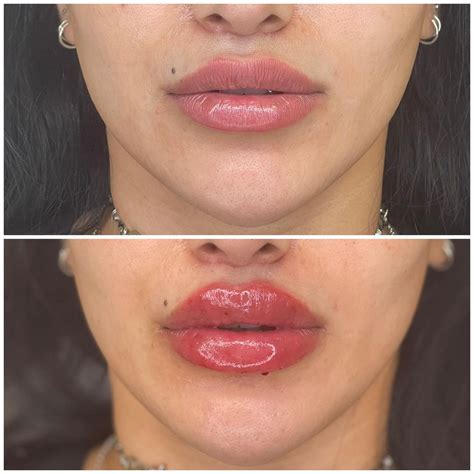 Expert Lip Filler Treatments at Scarlett's World