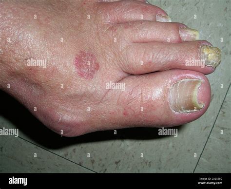 Athlete's foot, or tinea pedis, is a form of ringworm, a disease caused by a fungal infection of ...