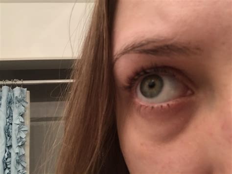 I have a scar through the middle of my eyebrow where hair never grows ...