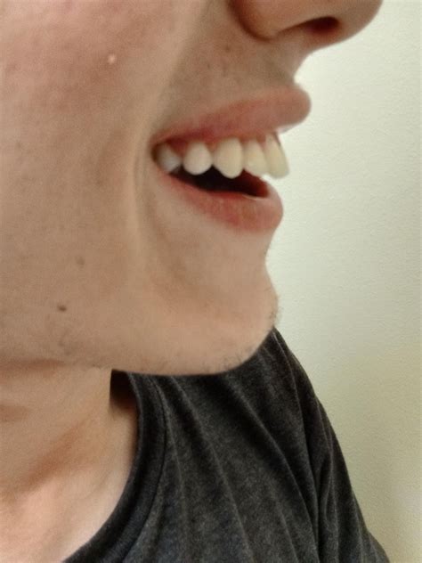 Are my two front teeth too big? : r/Invisalign