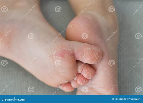 Enterovirus Leg Arm Mouth Skin Peeled Off On The Body Of A Child ...