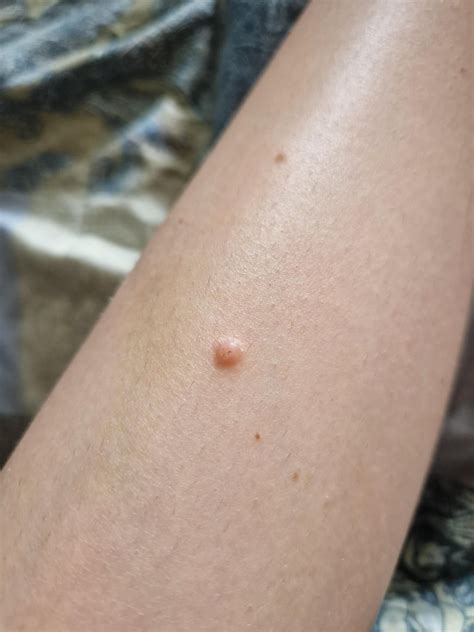 Bump on leg : r/DermatologyQuestions