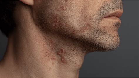 Why You Get Pimples on Your Neck and How to Treat Them - Rumbie