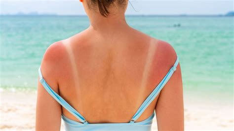 Sunburn Quiz - Doquizzes