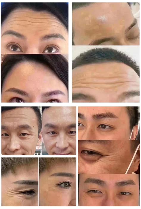 150u New Antiwrinkle Treatment Smooth Crows Feet Forehead Frown Lines Lip Lines Bunny Lines ...