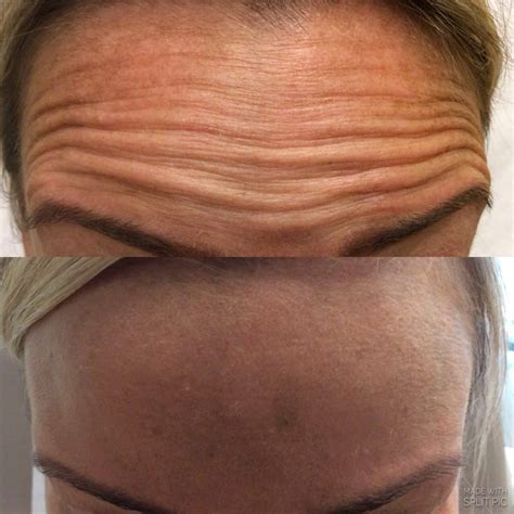 Botox Before and After Pictures - Deep Forehead Wrinkle, Lips