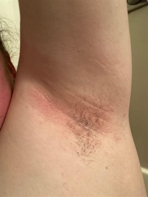 Help!! Very itchy armpit rash. Goes away and keeps coming back. : r/medical_advice