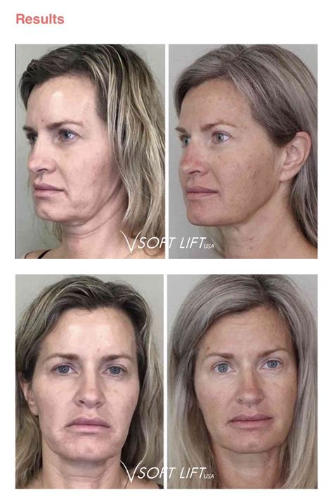 Facial Threads Facelift