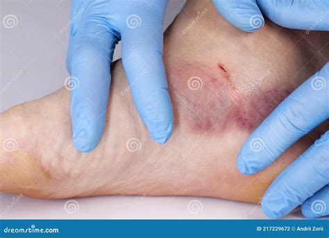 Doctor is Examining an Injured Foot with Bruise and Scratch. Bruise on ...