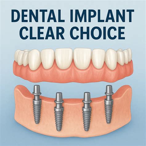 Dental Implant Clear Choice: A Complete Guide - Redent Clinic - Oral and Dental Health